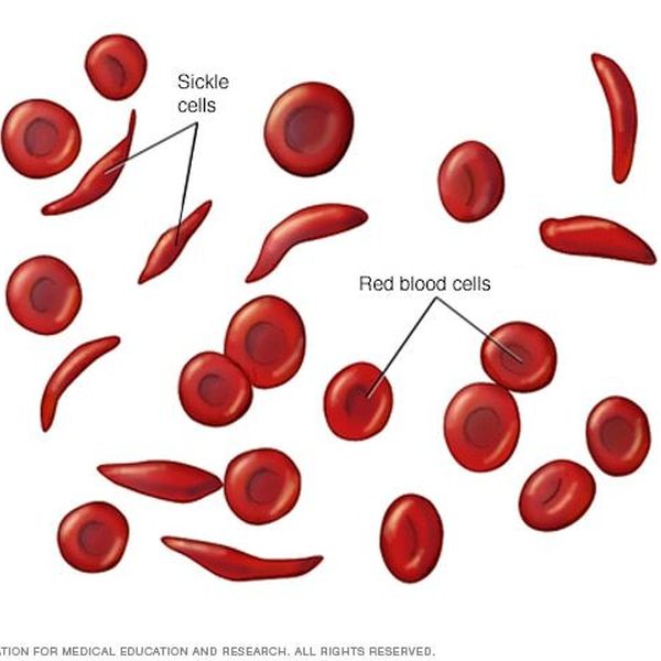 Sickle Cell Anemia Disease Essay Examples