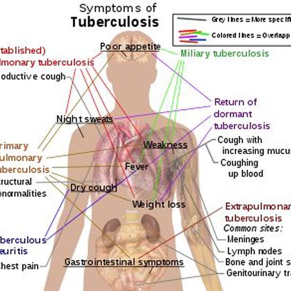 Tuberculosis Disease Essay Examples