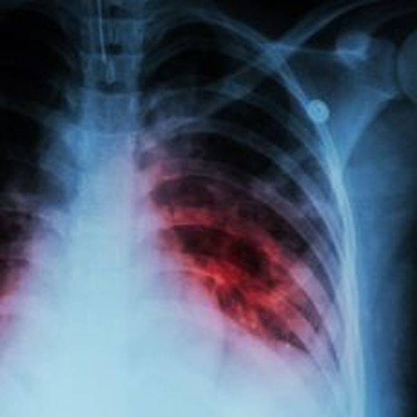 Tuberculosis Essay Examples